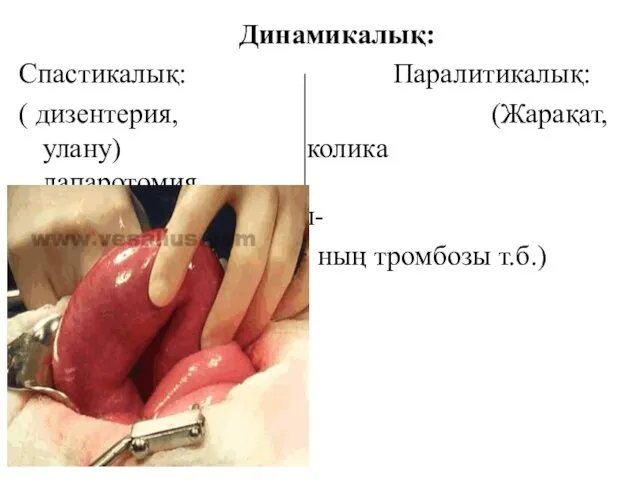 Динамикалық: Спастикалық: Паралитикалық: ( дизентерия, (Жарақат, улану) колика лапаротомия, шажырқай тамырлары- ның тромбозы т.б.)