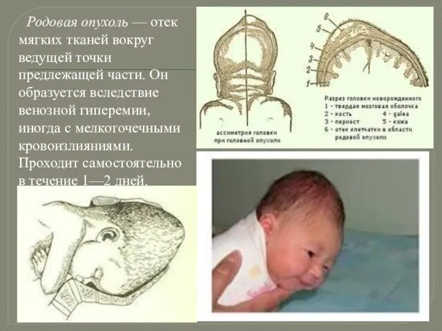 Родовая опухоль — отек мягких тканей вокруг ведущей точки предлежащей части.