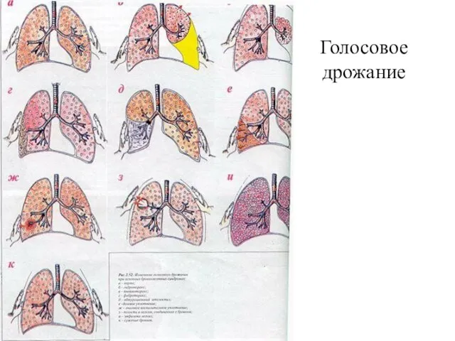 Голосовое дрожание