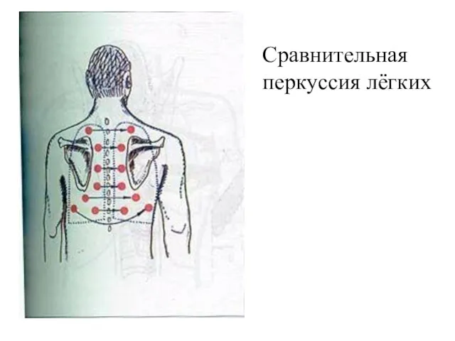 Сравнительная перкуссия лёгких Сравнительная перкуссия лёгких