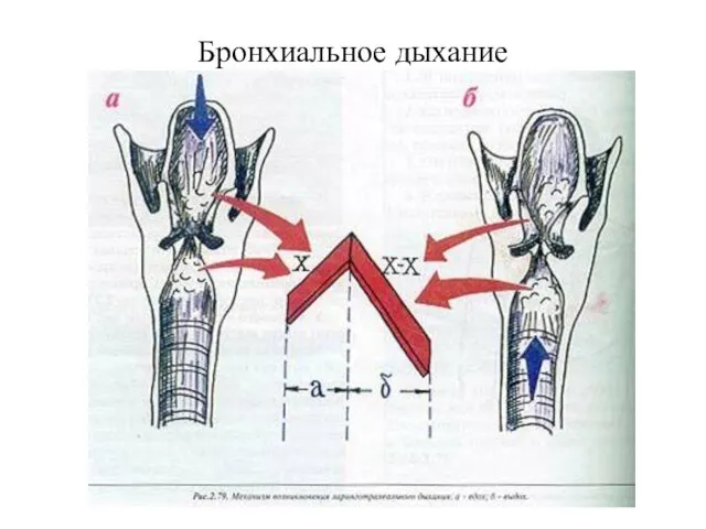 Бронхиальное дыхание