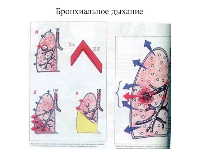 Бронхиальное дыхание