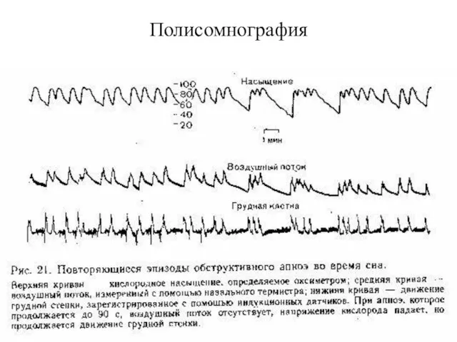 Полисомнография