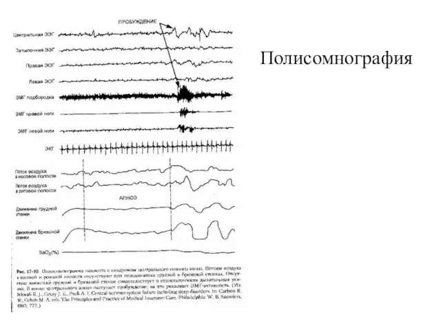 Полисомнография