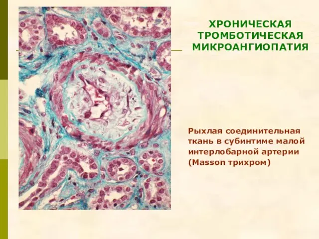 Рыхлая соединительная ткань в субинтиме малой интерлобарной артерии (Masson трихром) ХРОНИЧЕСКАЯ ТРОМБОТИЧЕСКАЯ МИКРОАНГИОПАТИЯ