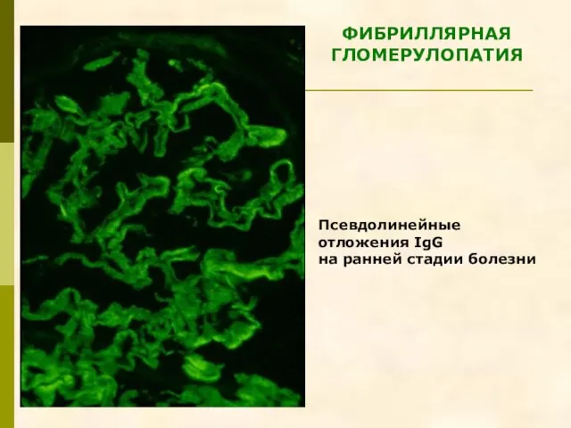 Псевдолинейные отложения IgG на ранней стадии болезни ФИБРИЛЛЯРНАЯ ГЛОМЕРУЛОПАТИЯ