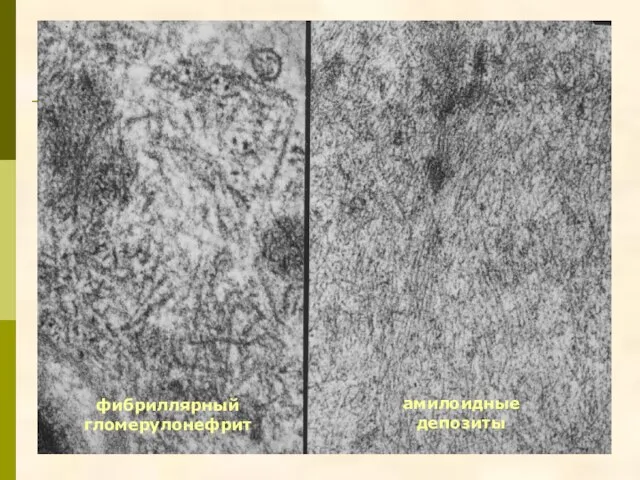 амилоидные депозиты фибриллярный гломерулонефрит