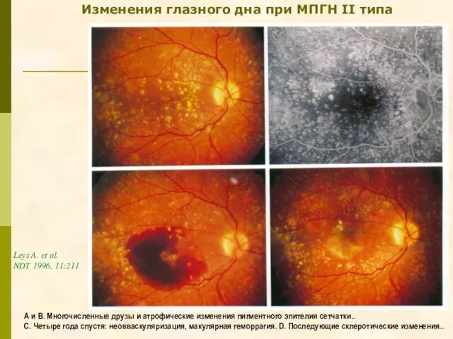 Изменения глазного дна при МПГН II типа А и В. Многочисленные