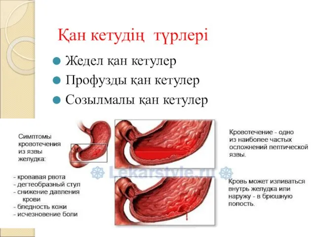 Жедел қан кетулер Профузды қан кетулер Созылмалы қан кетулер Қан кетудің түрлері