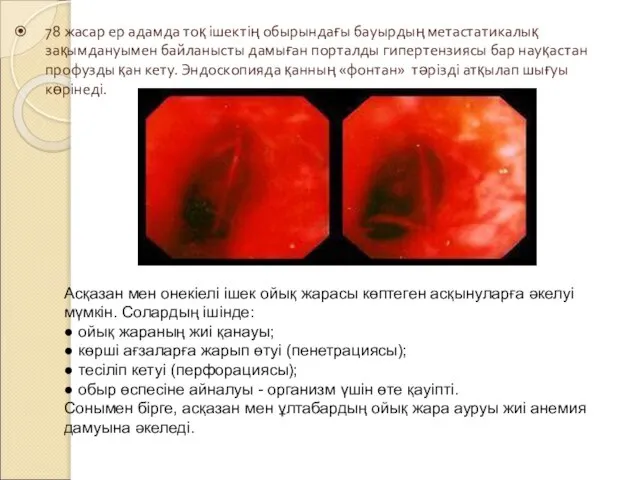 78 жасар ер адамда тоқ ішектің обырындағы бауырдың метастатикалық зақымдануымен байланысты