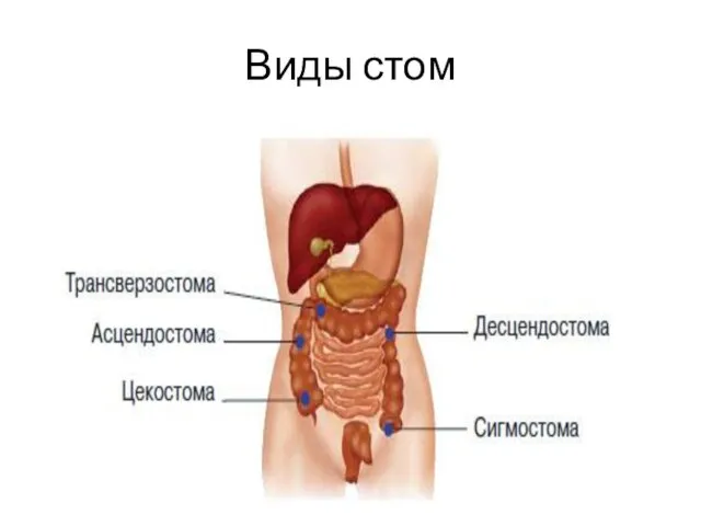 Виды стом