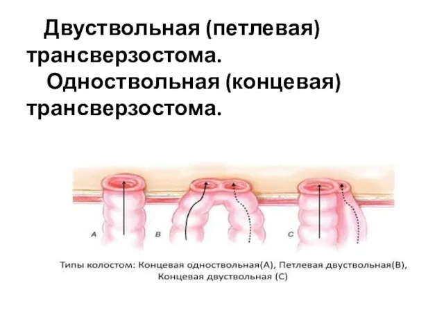 Двуствольная (петлевая) трансверзостома. Одноствольная (концевая) трансверзостома.