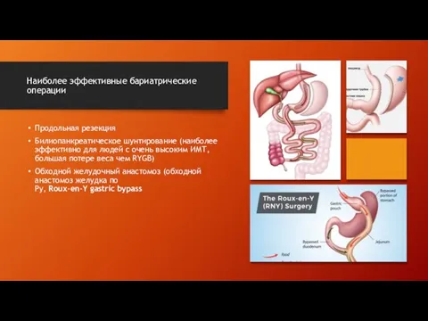 Наиболее эффективные бариатрические операции Продольная резекция Билиопанкреатическое шунтирование (наиболее эффективно для