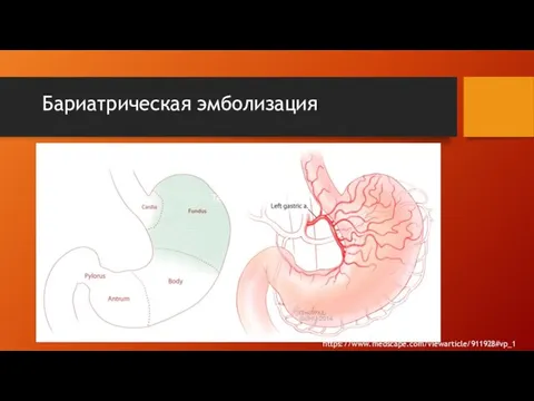 Бариатрическая эмболизация Текст слайда https://www.medscape.com/viewarticle/911928#vp_1