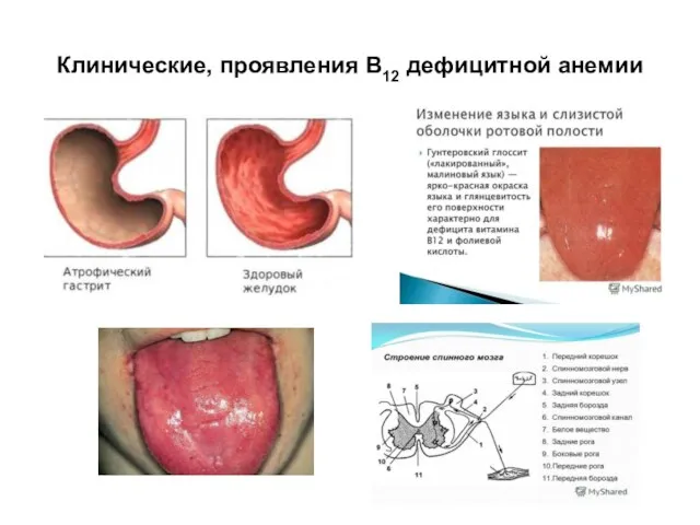 Клинические, проявления В12 дефицитной анемии