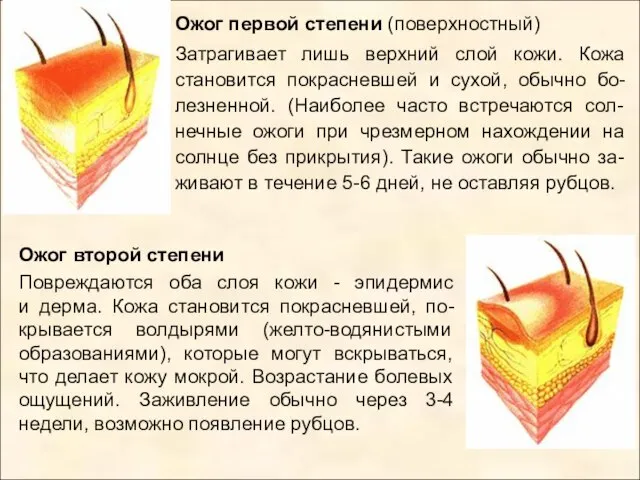 Ожог первой степени (поверхностный) Затрагивает лишь верхний слой кожи. Кожа становится