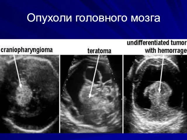 Опухоли головного мозга