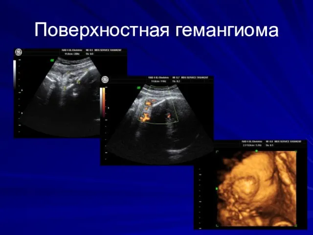 Поверхностная гемангиома