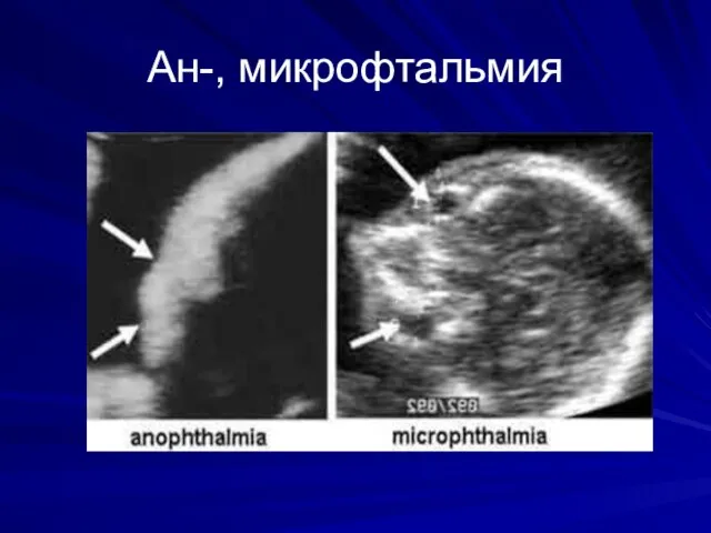 Ан-, микрофтальмия