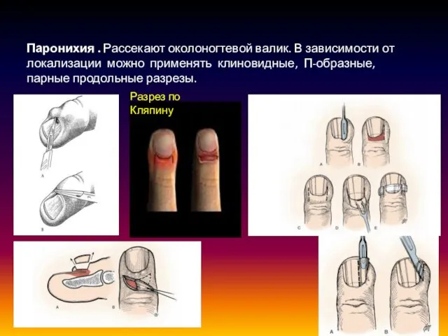 Паронихия . Рассекают околоногтевой валик. В зависимости от локализации можно применять