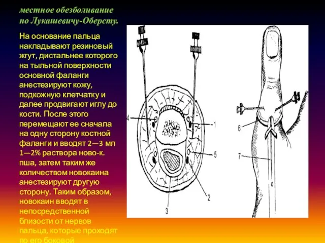 местное обезболивание по Лукашевичу-Оберсту. На основание пальца накладывают резиновый жгут, дистальнее