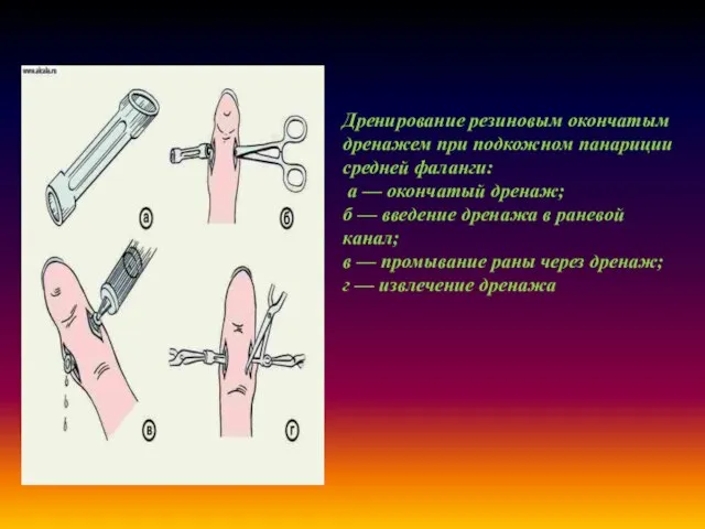 Дренирование резиновым окончатым дренажем при подкожном панариции средней фаланги: а —