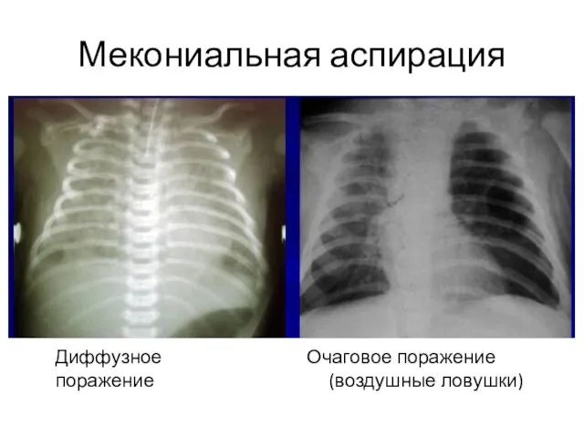 Мекониальная аспирация Диффузное поражение Очаговое поражение (воздушные ловушки)