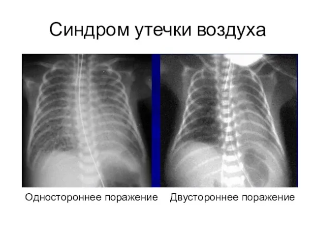 Синдром утечки воздуха Одностороннее поражение Двустороннее поражение