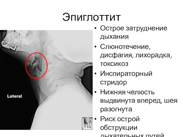 Эпиглоттит Острое затруднение дыхания Слюнотечение, дисфагия, лихорадка, токсикоз Инспираторный стридор Нижняя