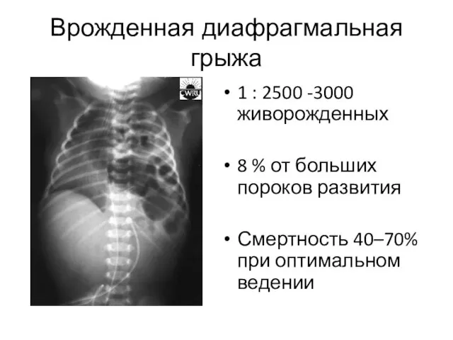 Врожденная диафрагмальная грыжа 1 : 2500 -3000 живорожденных 8 % от