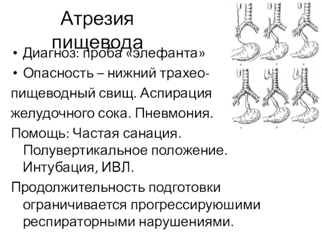 Атрезия пищевода Диагноз: проба «элефанта» Опасность – нижний трахео- пищеводный свищ.