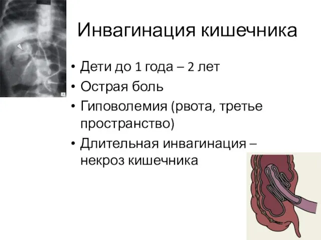 Инвагинация кишечника Дети до 1 года – 2 лет Острая боль