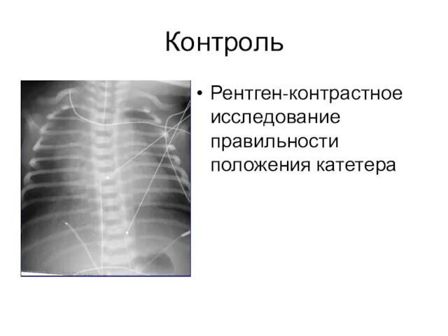 Контроль Рентген-контрастное исследование правильности положения катетера