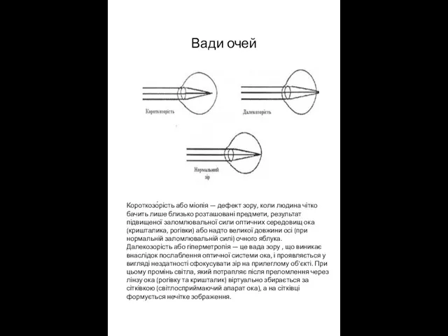 Вади очей Короткозо́рість або міопія — дефект зору, коли людина чітко