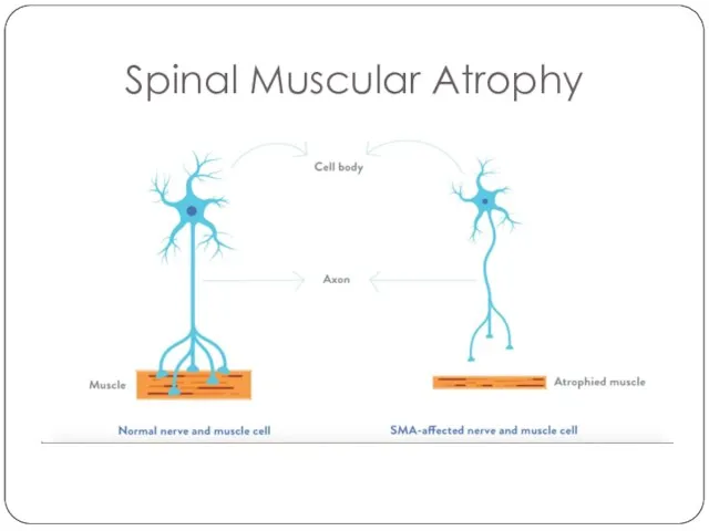 Spinal Muscular Atrophy