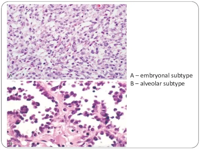 A – embryonal subtype B – alveolar subtype