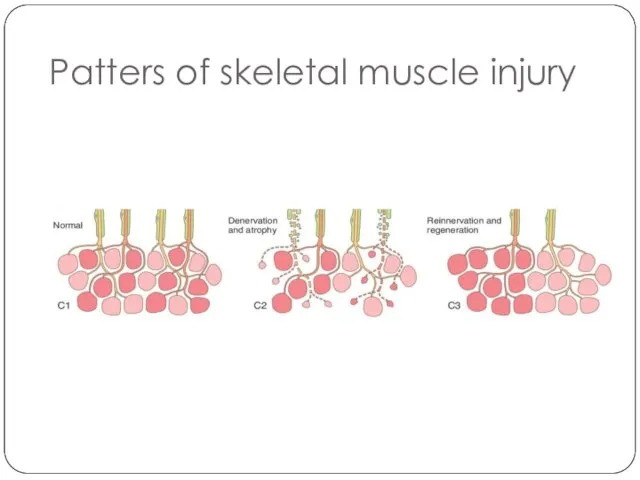 Patters of skeletal muscle injury