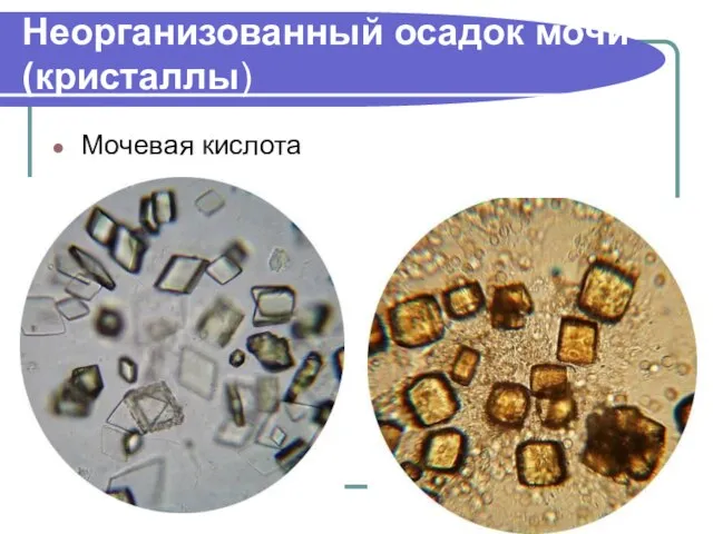 Неорганизованный осадок мочи (кристаллы) Мочевая кислота