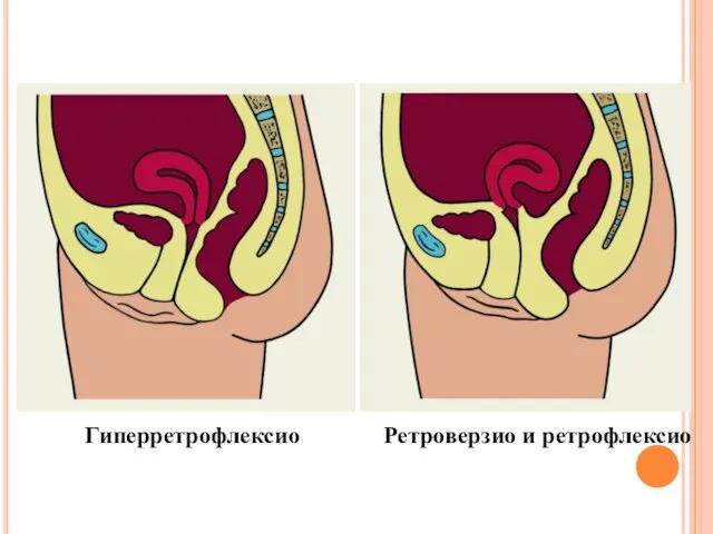 Гиперретрофлексио Ретроверзио и ретрофлексио