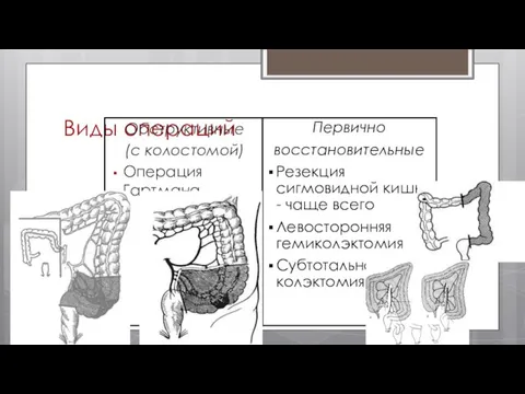 Виды операций Обструктивные (с колостомой) Операция Гартмана Первично восстановительные Резекция сигмовидной