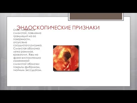 ЭНДОСКОПИЧЕСКИЕ ПРИЗНАКИ Отек, гиперемия слизистой, появление грануляций на ее поверхности, отсутствие