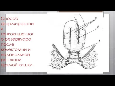 Способ формирования тонкокишечного резервуара после колектомии и наданальной резекции прямой кишки.