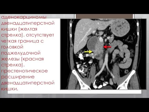 стенотическое поражение двенадцатиперстной кишки в результате аденокарциномы двенадцатиперстной кишки (желтая стрелка).