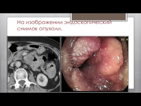 На изображении эндоскопический снимок опухоли.