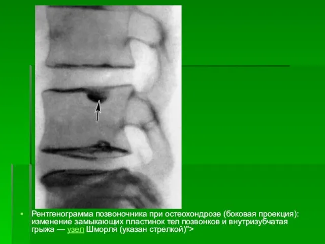 Рентгенограмма позвоночника при остеохондрозе (боковая проекция): изменение замыкающих пластинок тел позвонков