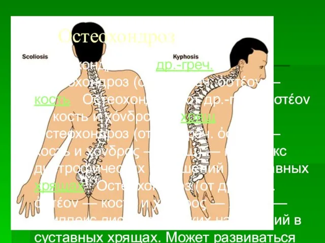 Остеохондроз Остеохондроз (от др.-греч. Остеохондроз (от др.-греч. ὀστέον — кость Остеохондроз