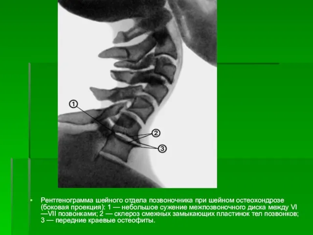 Рентгенограмма шейного отдела позвоночника при шейном остеохондрозе (боковая проекция): 1 —