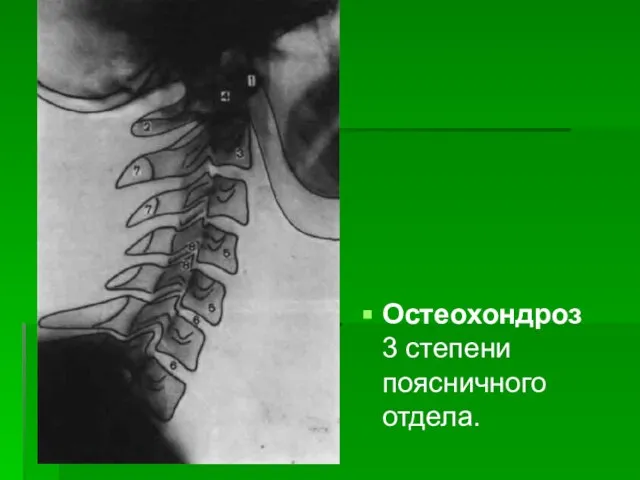 Остеохондроз 3 степени поясничного отдела.