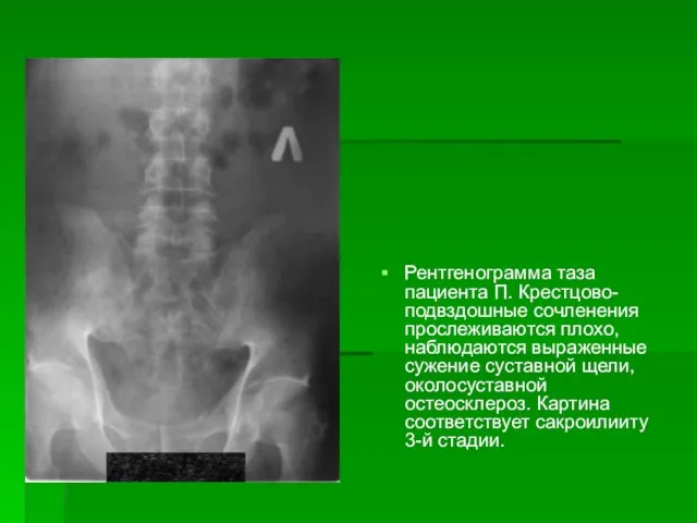 Рентгенограмма таза пациента П. Крестцово-подвздошные сочленения прослеживаются плохо, наблюдаются выраженные сужение