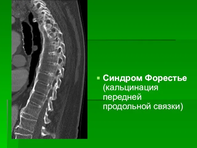 Синдром Форестье (кальцинация передней продольной связки)